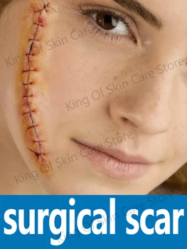 Odstránenie Kožných Výrastkov Krém Keloidné Chirurgické Jazvy Liečby Obrázok