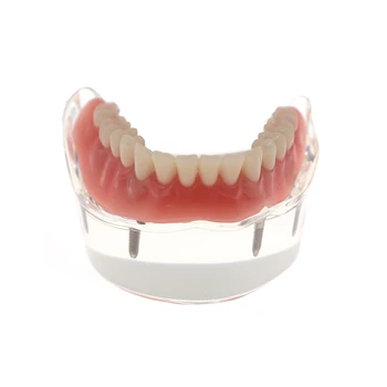 1 Ks Zubná Zuby Štúdia Model Overdenture Nižšej 4 Zubné Demo Modely 6003 Obrázok