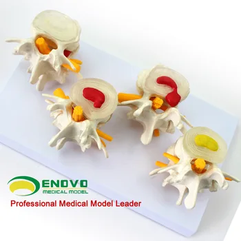 Enovo Yinuo Lekárske Kombinácia Modelu Normálneho Bedrových Lézie Kosti Model Pre Výučbu Na Katedre Medzistavcové Platničky Obrázok