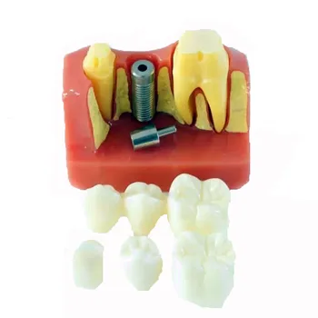 4 Krát Zubný Implantát Model pre Vzdelávanie Zubného Anatomické Lekárskej Vedy a Vyučovania Obrázok