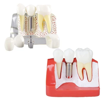 Zuby Demonštrácia Model Implantát Vymeniteľné Analýza Koruny Most, Komunikácia Medzi Pacientom A Lekárom Obrázok
